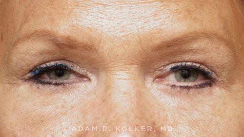 Blepharoplasty After Image Patient 16 Front View