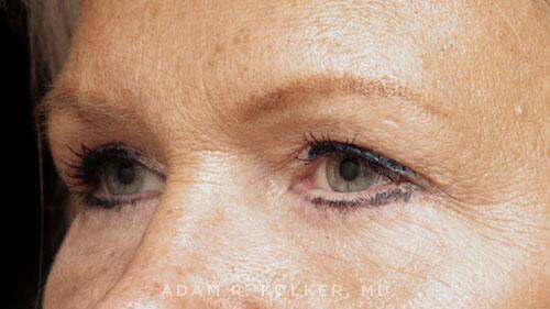 Blepharoplasty After Image Patient 16 Oblique View
