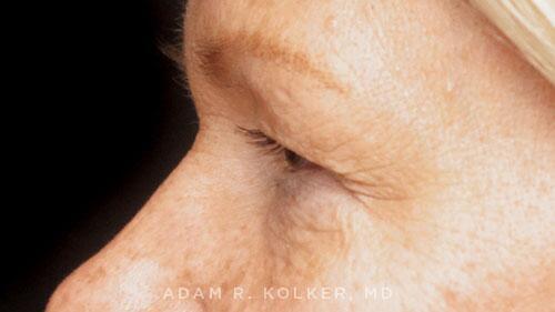 Blepharoplasty Before Image Patient 16 Side View