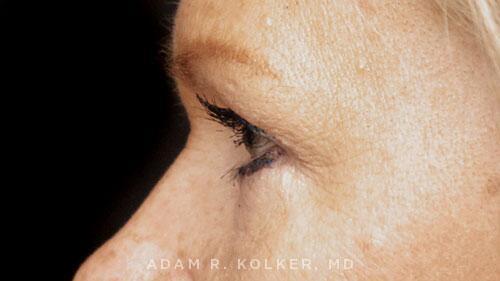 Blepharoplasty After Image Patient 16 Side View
