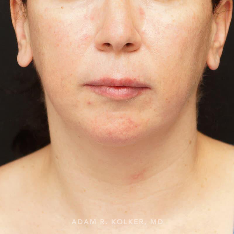 Chin Implant Before and After Image