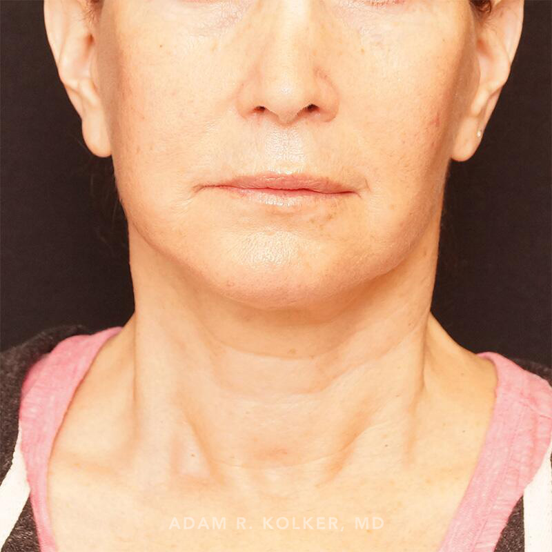 Facelift After Image Patient 01 Front View