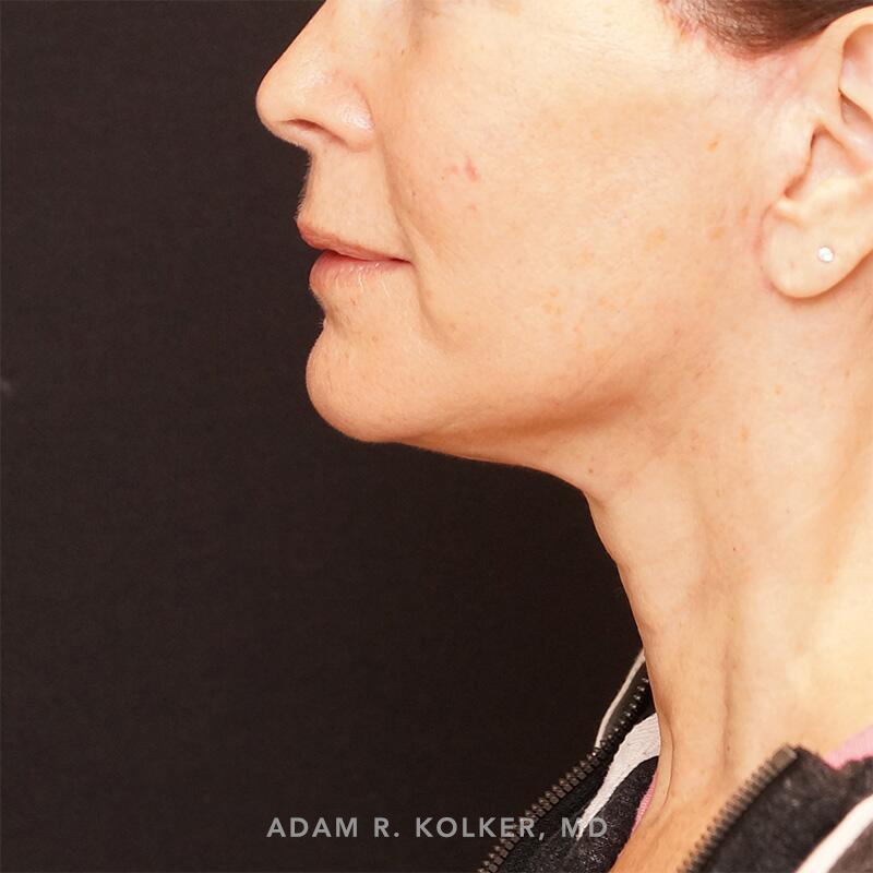 Facelift After Image Patient 01 Side View