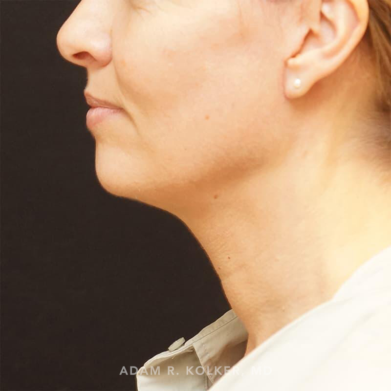 Facelift After Image Patient 03 Side View