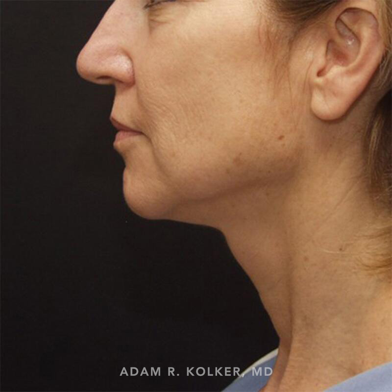 Facelift Before Image Patient 04 Side View