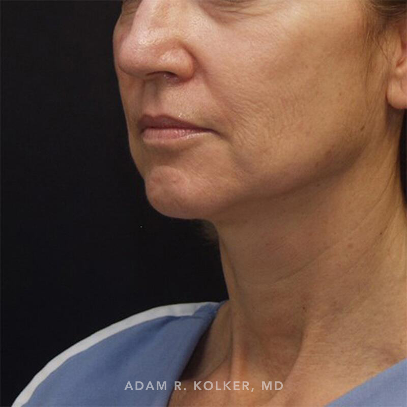 Facelift Before Image Patient 06 Oblique View