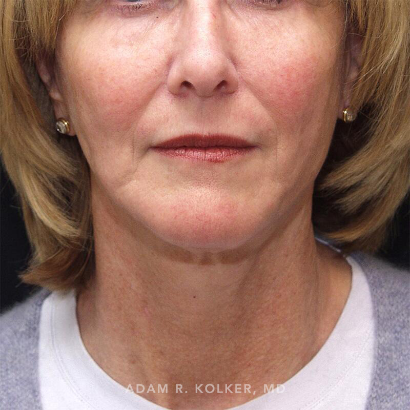 Facelift After Image Patient 07 Front View