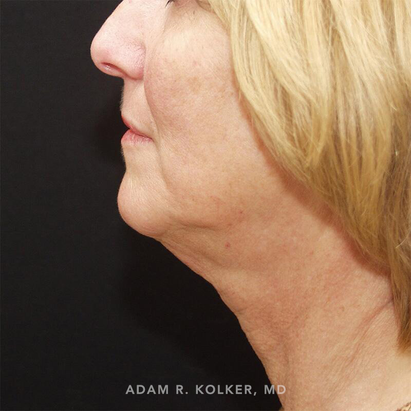 Facelift Before Image Patient 07 Side View