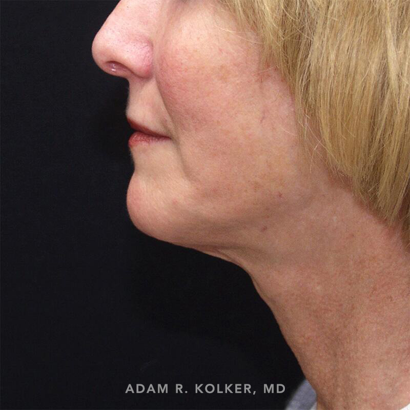 Facelift After Image Patient 07 Side View