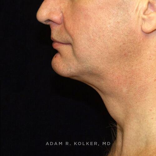 Neck Lift Before and After Image