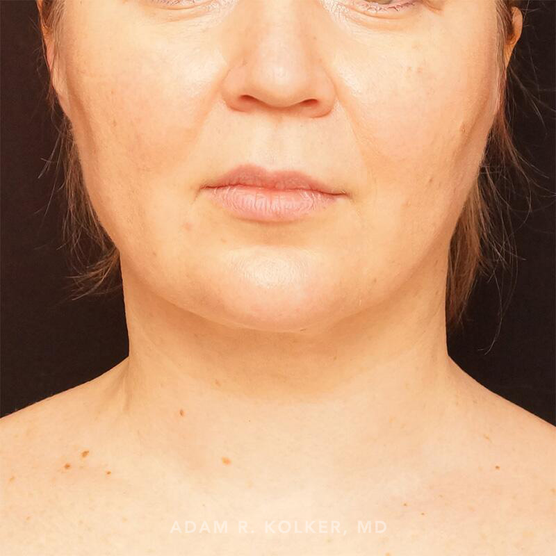 Neck Liposuction After Image Patient 01 Front View