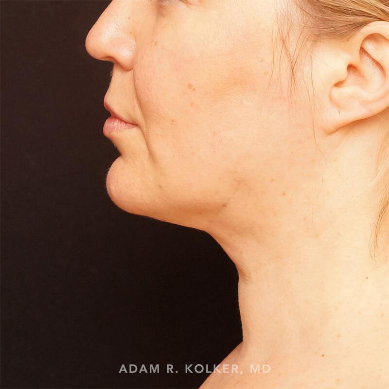 Neck Liposuction After Image Patient 01 Side View
