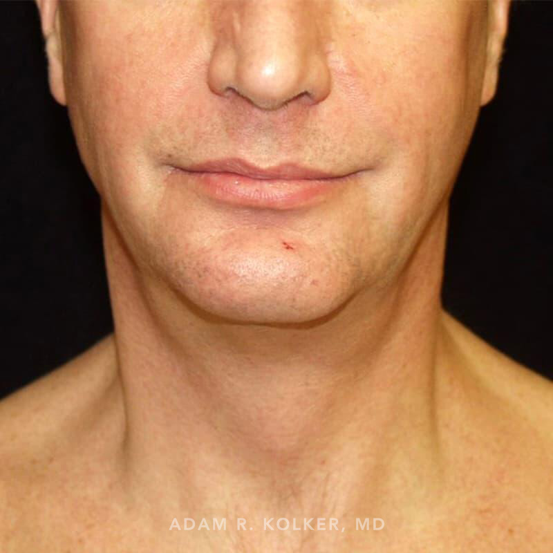 Neck Liposuction After Image Patient 02 Front View