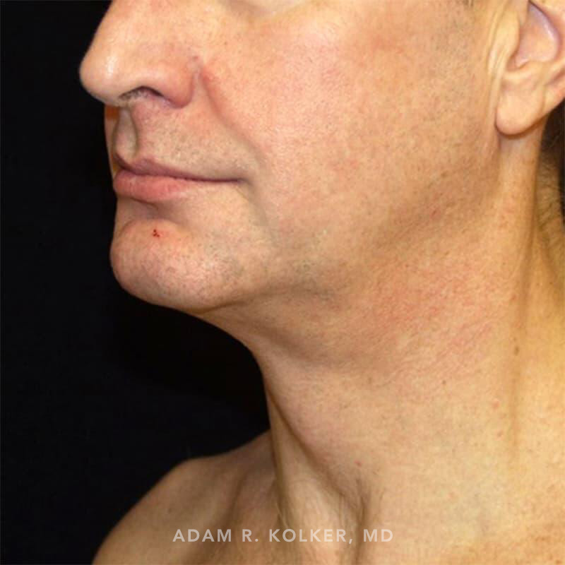 Neck Liposuction After Image Patient 02 Oblique View