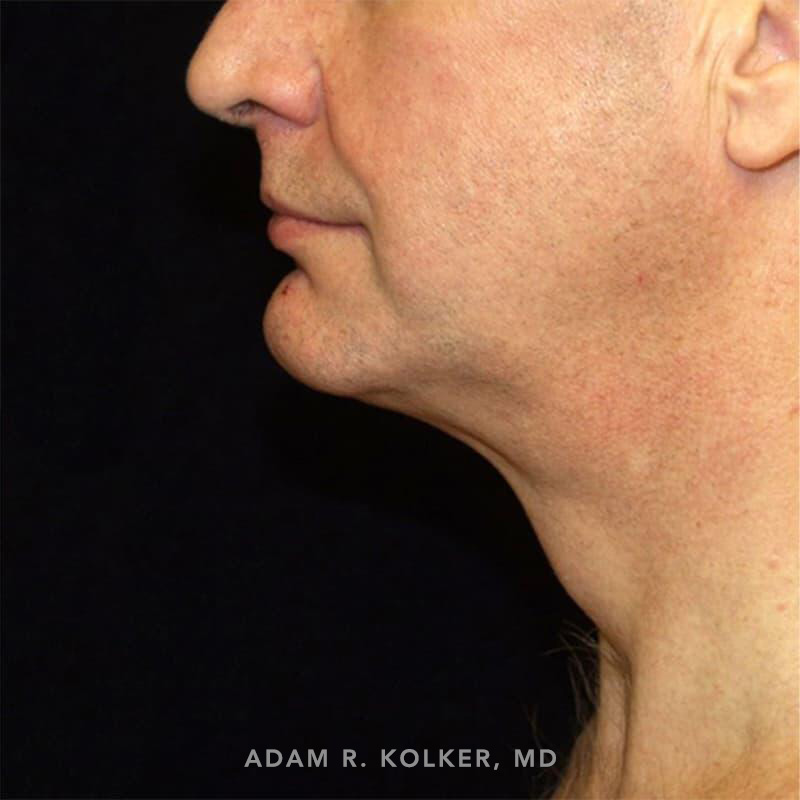 Neck Liposuction After Image Patient 02 Side View
