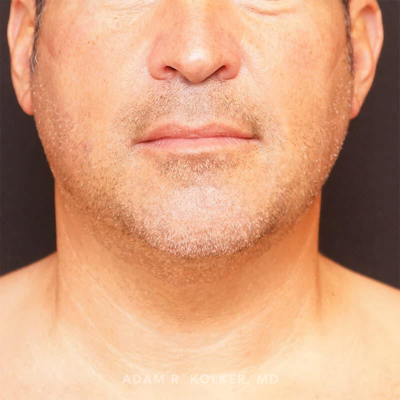 Neck Liposuction After Image Patient 04 Front View