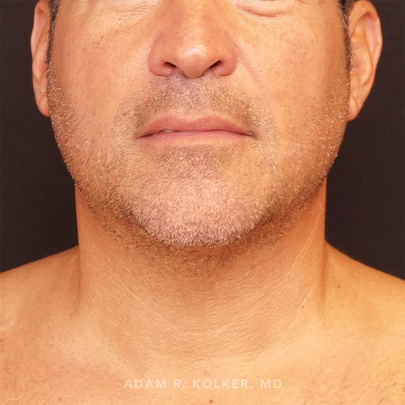 Neck Liposuction After Image Patient 04 Front View