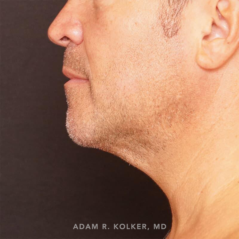 Neck Liposuction After Image Patient 04 Side View