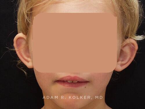Otoplasty Before and After Image