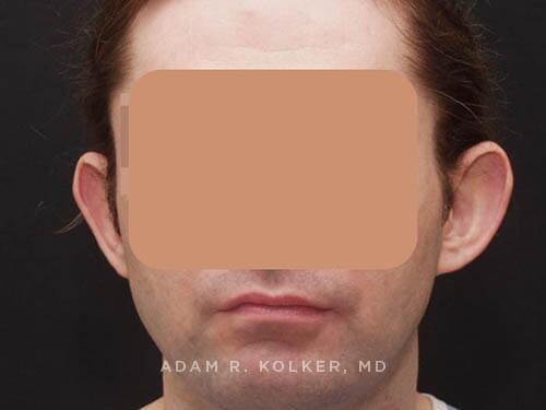 Otoplasty Before and After Image