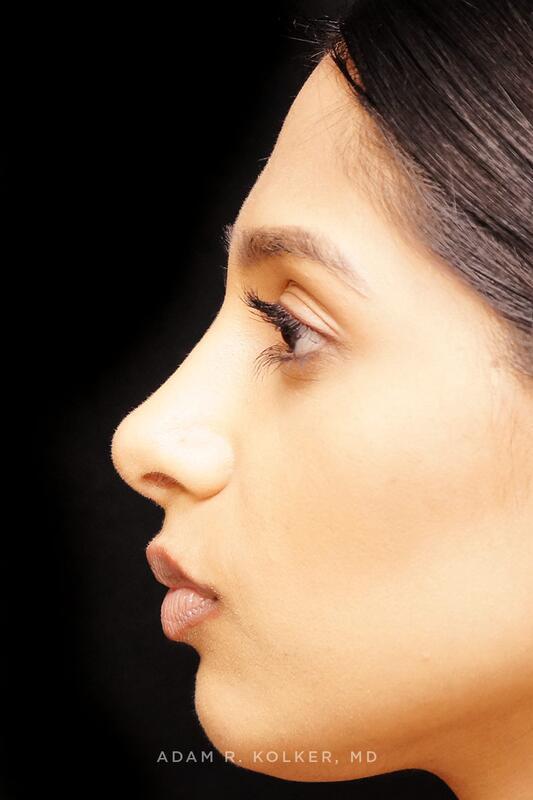 Rhinoplasty After Image Patient 02 Side View