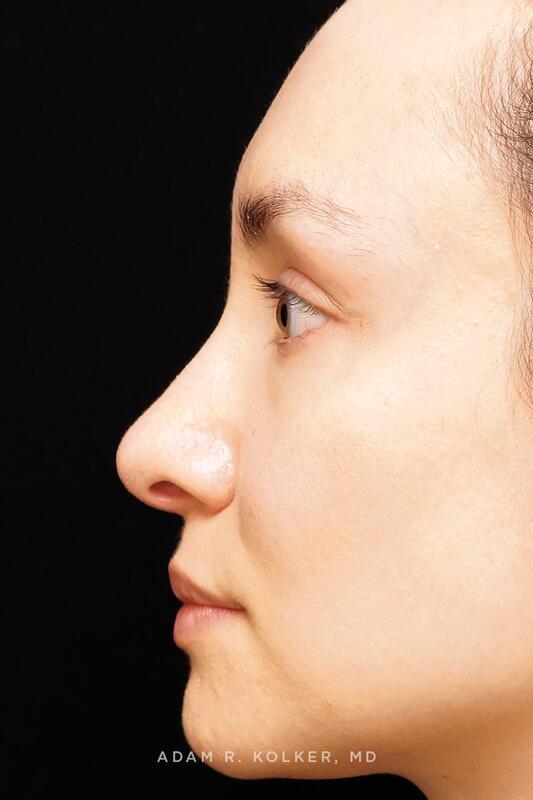 Rhinoplasty After Image Patient 04 Side View