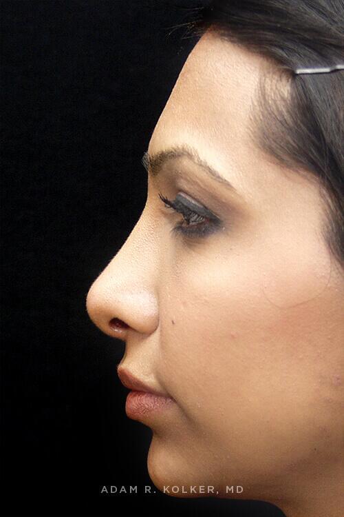 Rhinoplasty After Image Patient 06 Side View