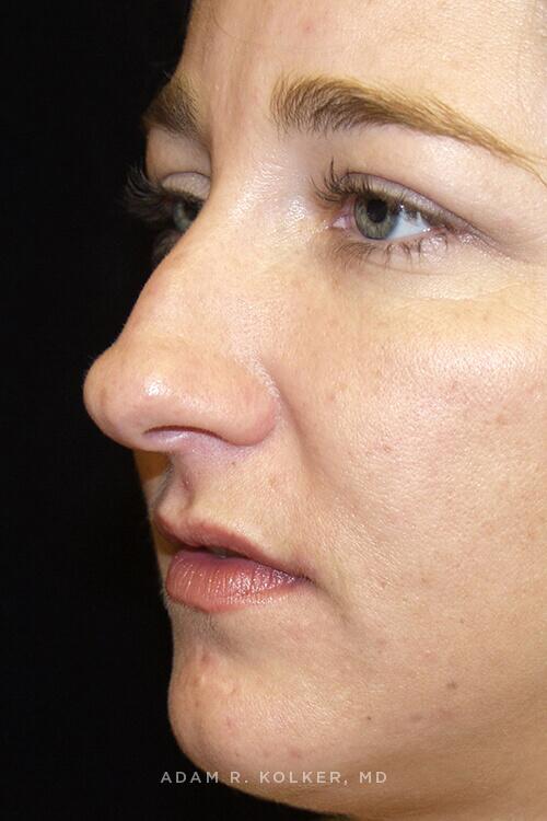 Rhinoplasty Before Image Patient 08 Oblique View
