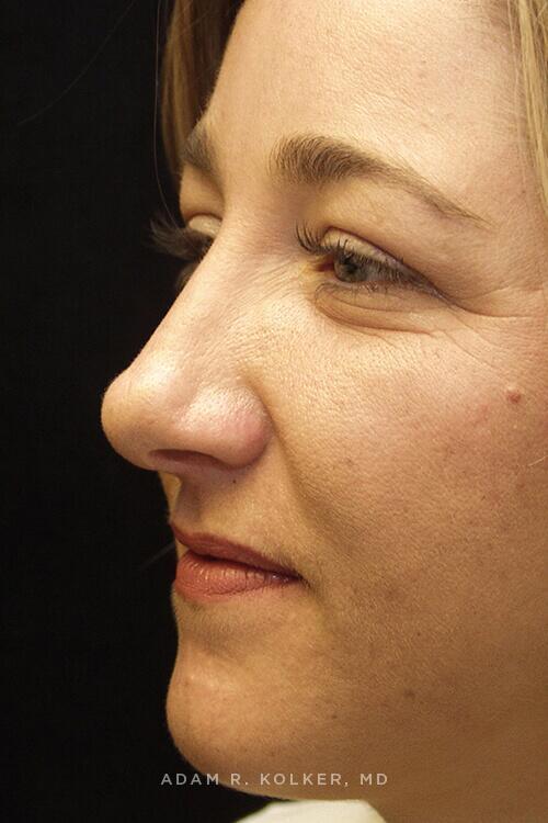 Rhinoplasty After Image Patient 08 Oblique View