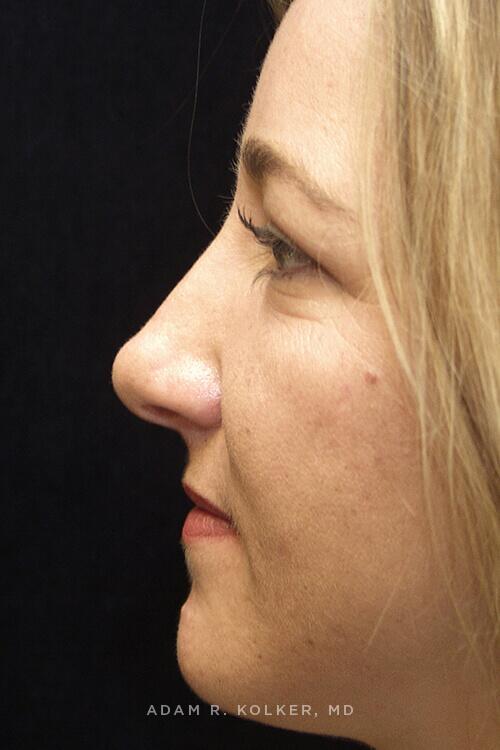 Rhinoplasty After Image Patient 08 Side View