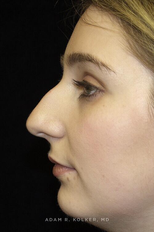 Rhinoplasty Before Image Patient 09 Side View