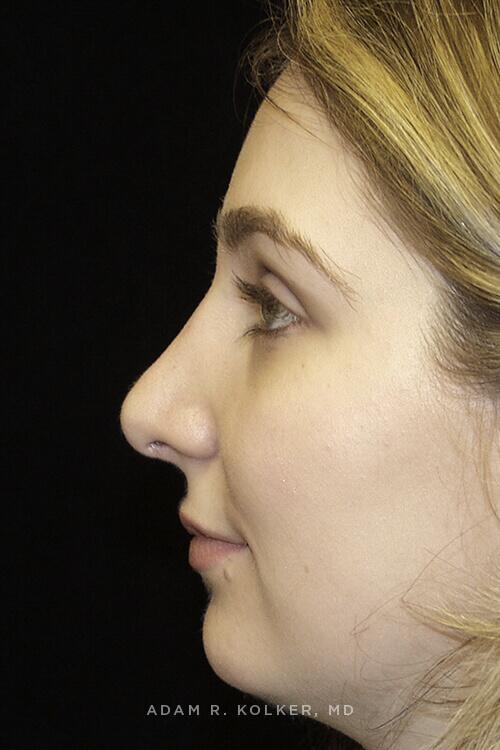 Rhinoplasty After Image Patient 09 Side View