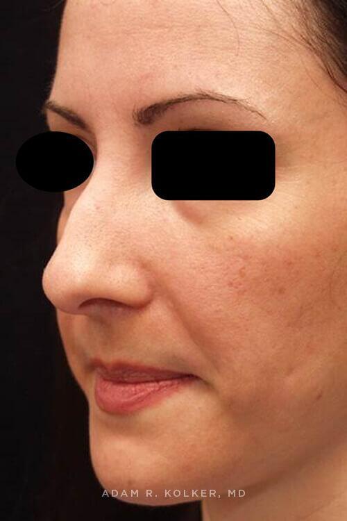 Rhinoplasty Before Image Patient 10 Oblique View