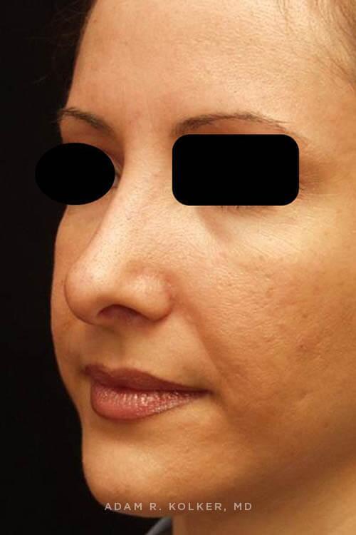 Rhinoplasty After Image Patient 10 Oblique View