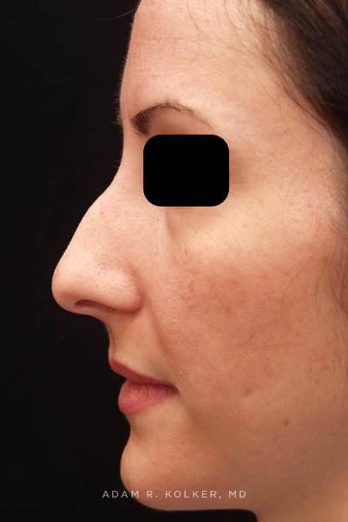 Rhinoplasty Before Image Patient 10 Side View
