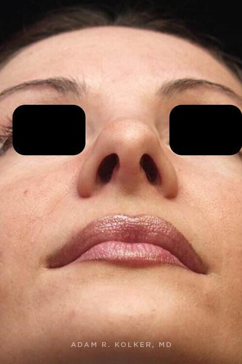 Rhinoplasty After Image Patient 10 Side View