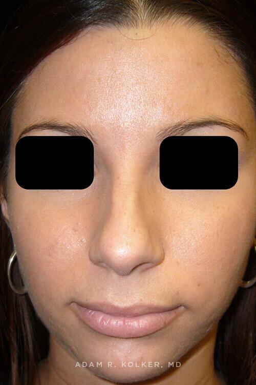 Rhinoplasty Before Image Patient 11 Front View