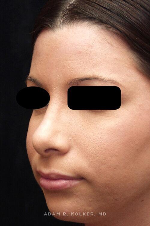 Rhinoplasty After Image Patient 11 Oblique View