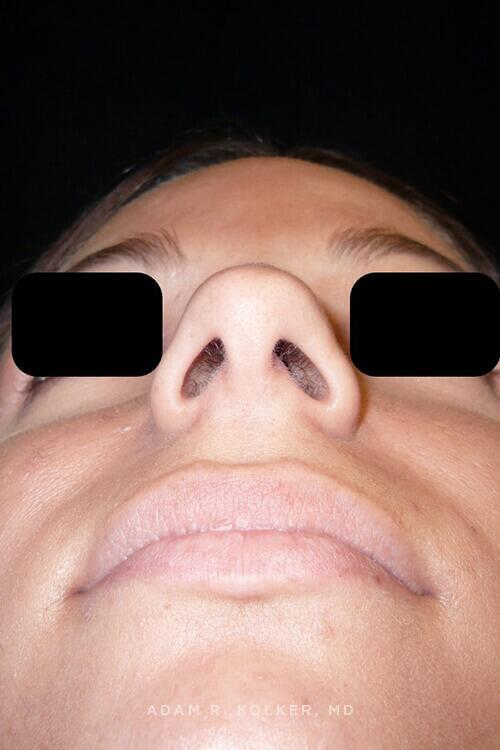 Rhinoplasty After Image Patient 11 Side View